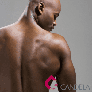 Chest Back Shoulder Laser Treatment
