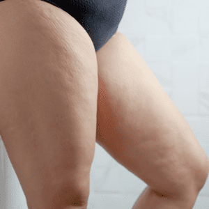 Fat Dissolving Injections for Thighs