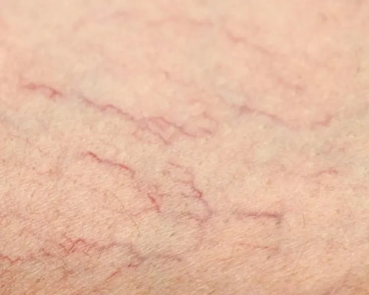 6636a619041a5425255f1ba3_62c758a6f9716178ef0cdb45_Spider20Veins20BIG-1